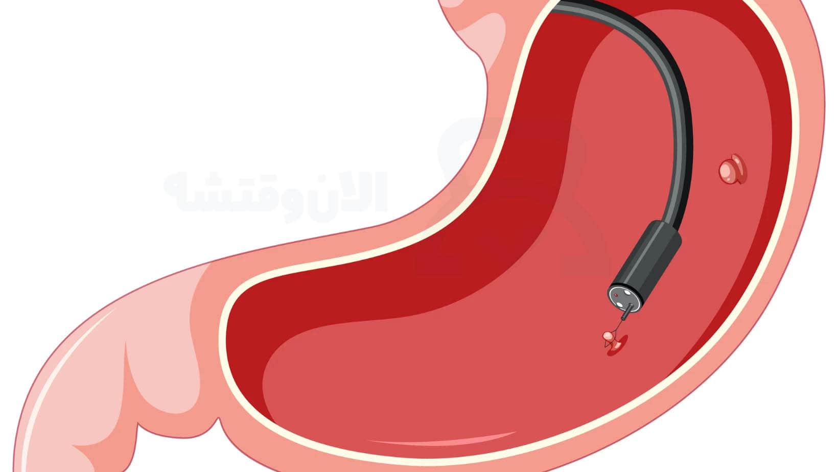 روش دقیق انجام بوتاکس معده