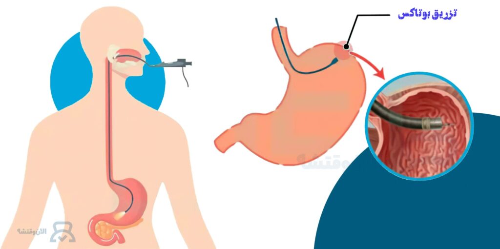 عوارض بوتاکس معده در دراز مدت